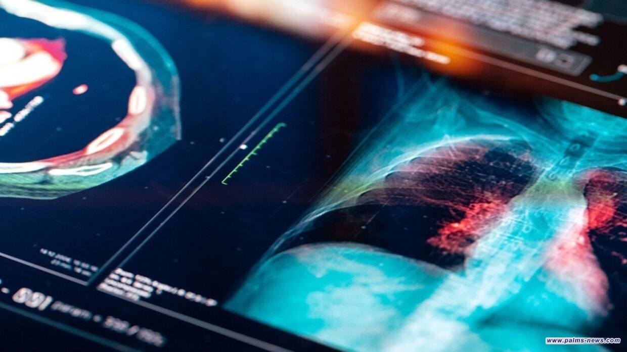 طبيب روسي يحذر من تطور سرطان الرئة دون أعراض