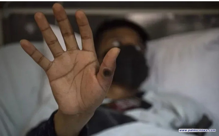 الأردن تسجل إصابة بجدري القردة