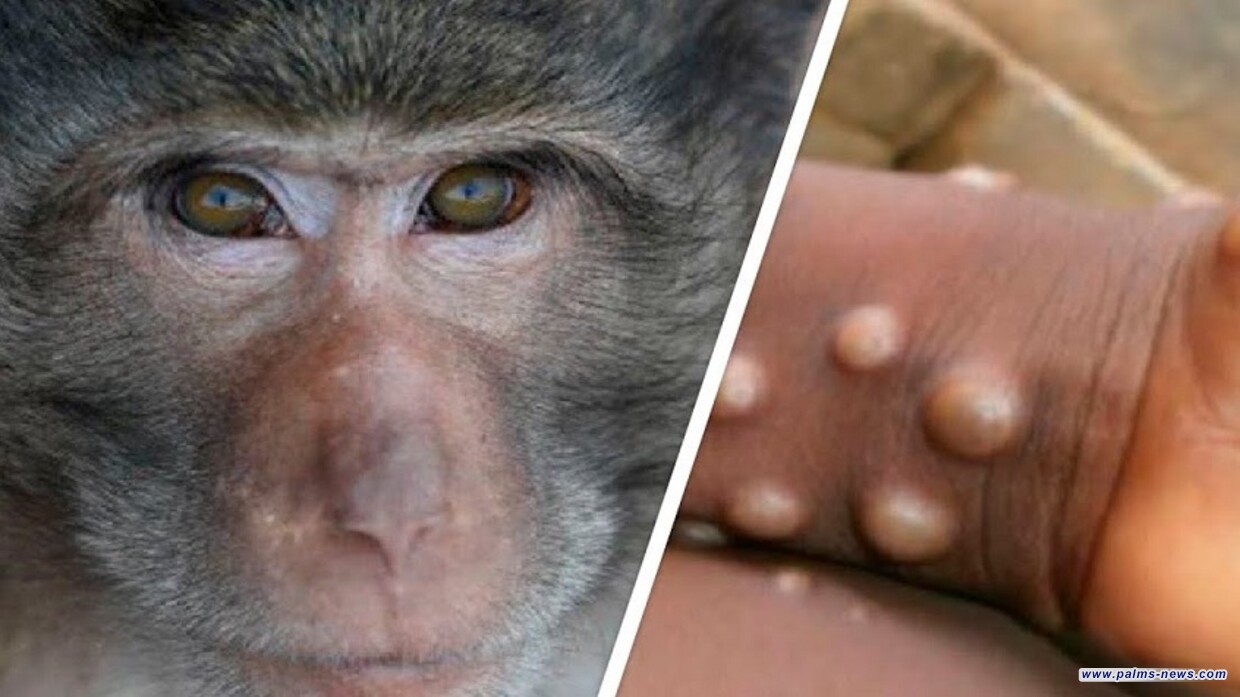 سلالة جديدة من جدري القردة مكتشفة في الكونغو تتسلل إلى تايلاند والسويد