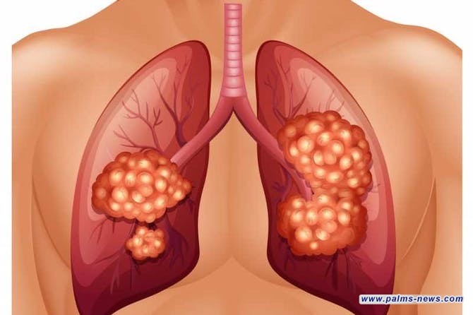 "تهديد صامت" يصيب غير المدخنين بسرطان الرئة