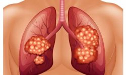 "تهديد صامت" يصيب غير المدخنين بسرطان الرئة